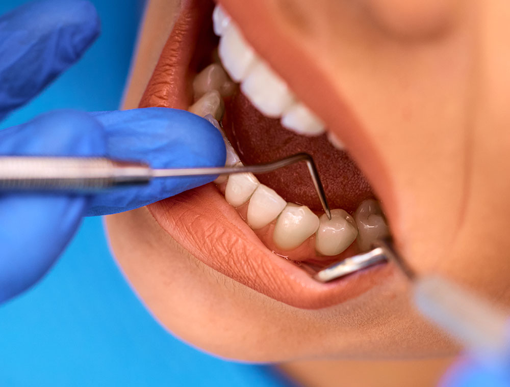 Dentista a Milano Rimozione Amalgama