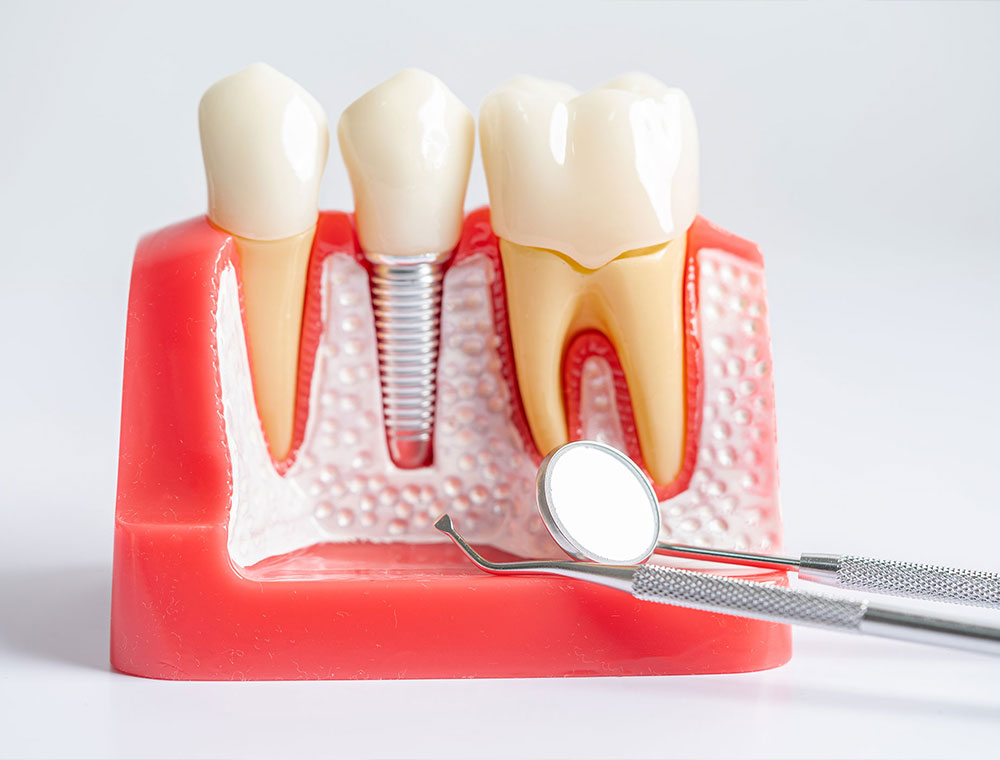 Dentista a Milano Implantologia e Chirurgia