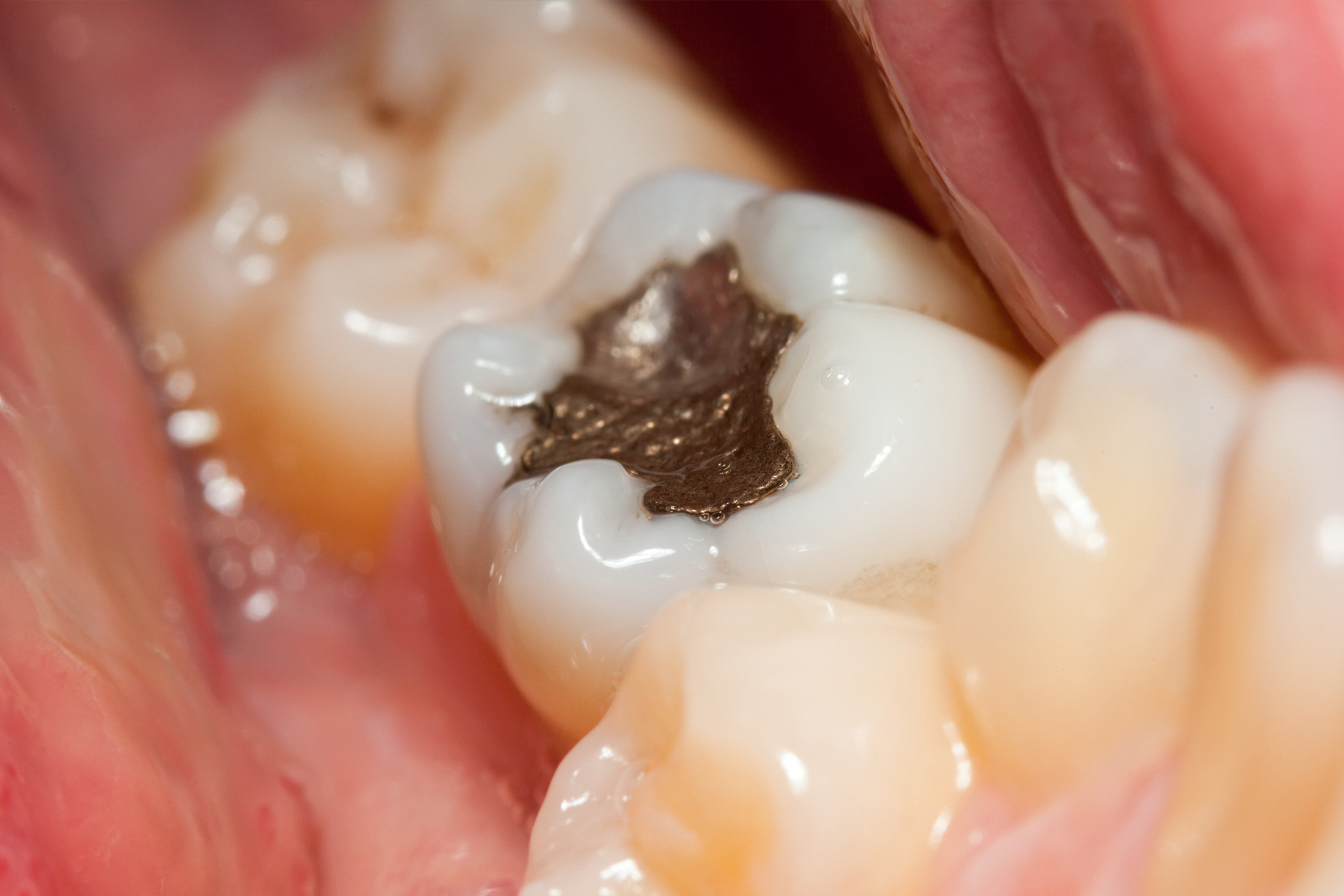 Dentista a Milano Rimozione Amalgama